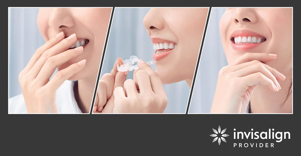 invisalign-smile