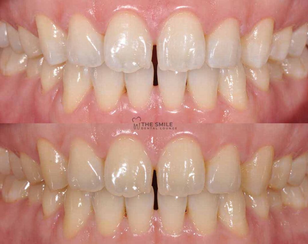 Teeth Whitening Johor Bahru Before After