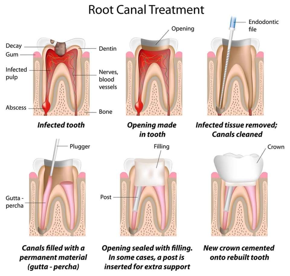 Root Canal JB