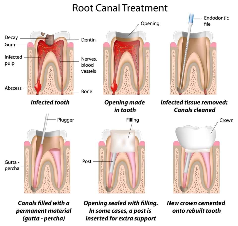 root canal treatment procedure