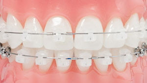 Ceramic braces
