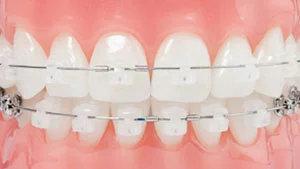 Ceramic braces