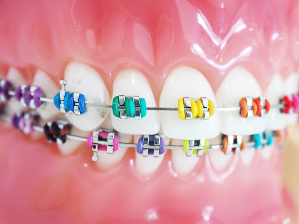 Conventional metal braces