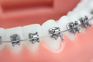 self ligating braces