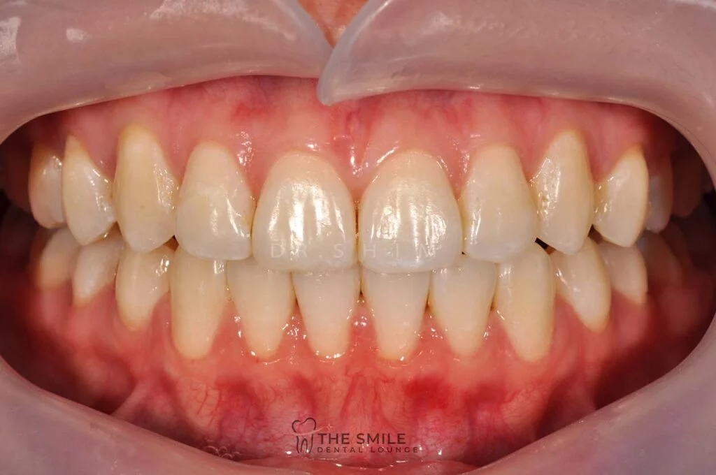 Teeth Whitening Before