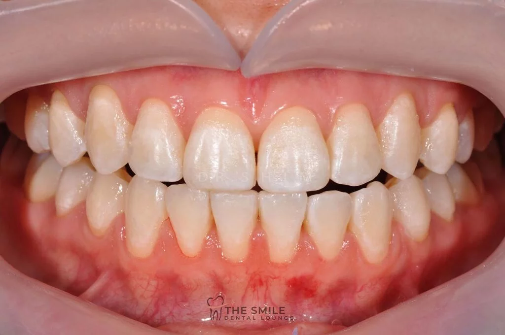 Teeth Whitening After
