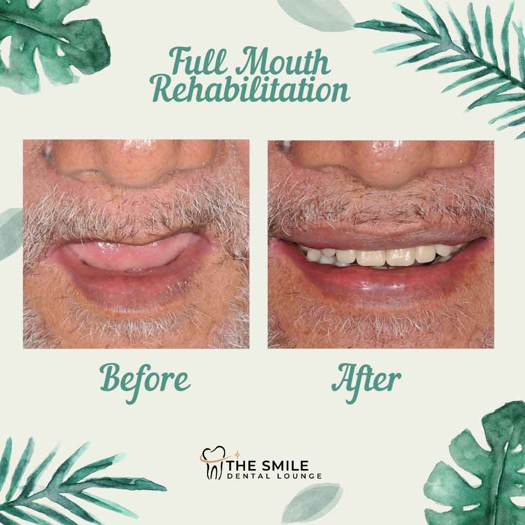 Full Mouth Rehabilitation Johor Bahru