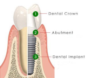 Implant crown