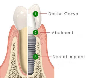 Implant crown