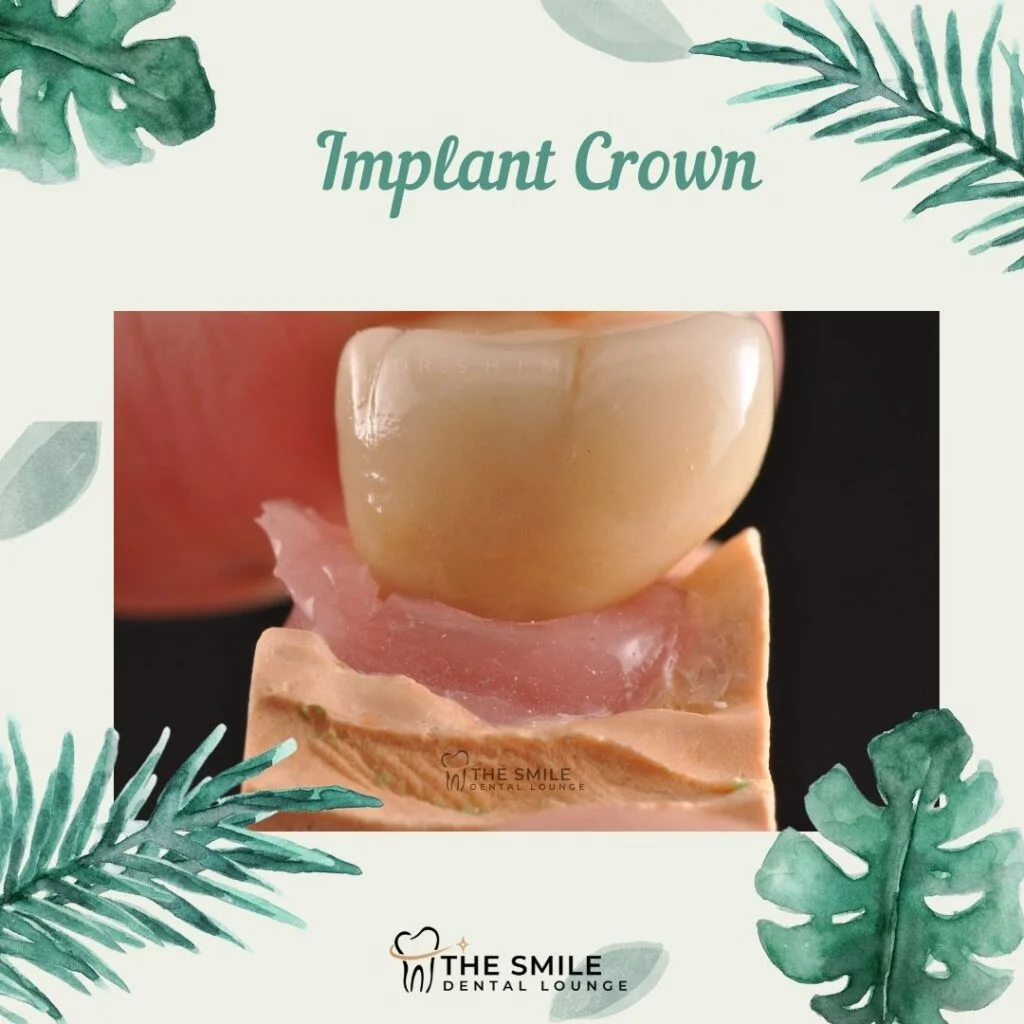 Implant on tooth model