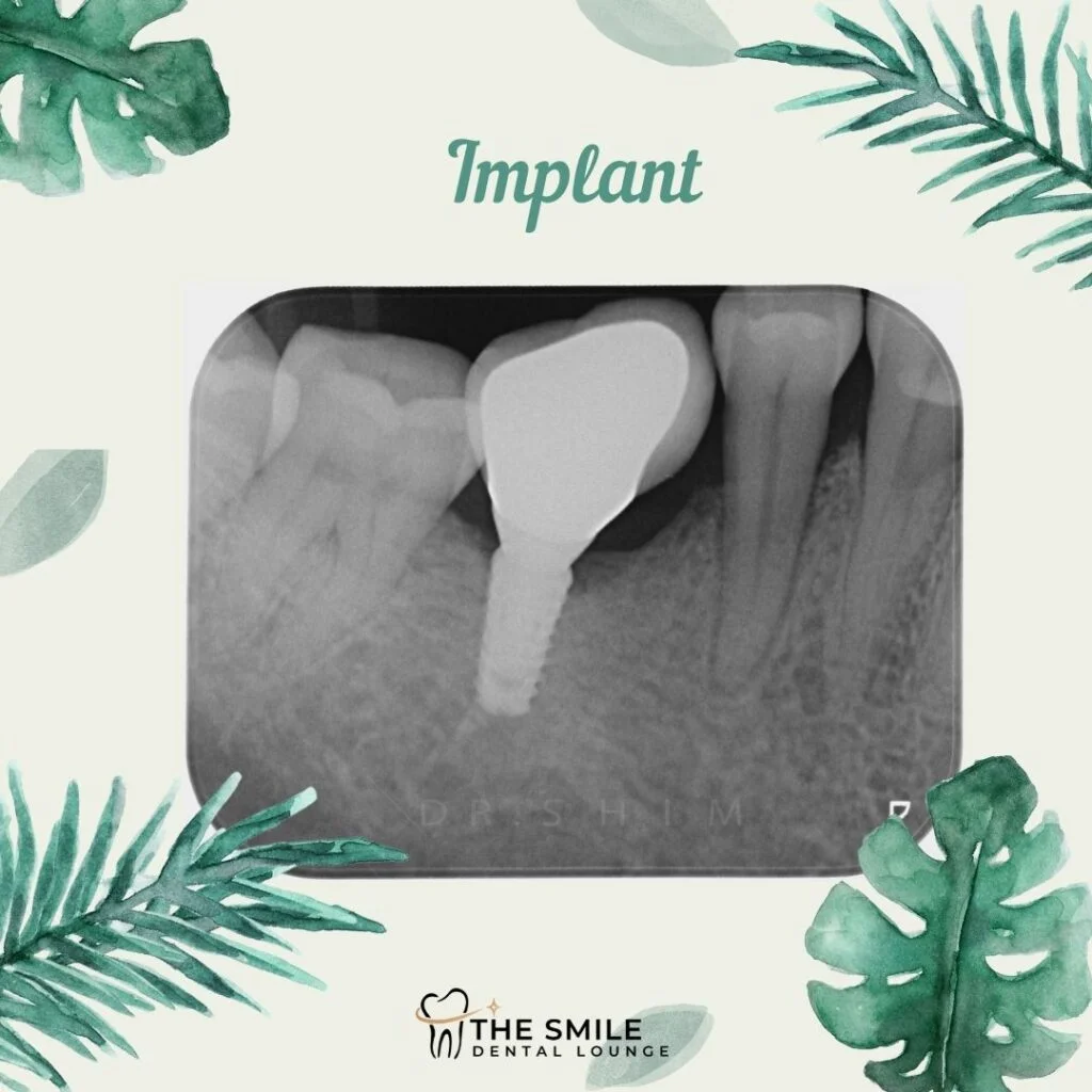 Implant X ray Johor Bahru