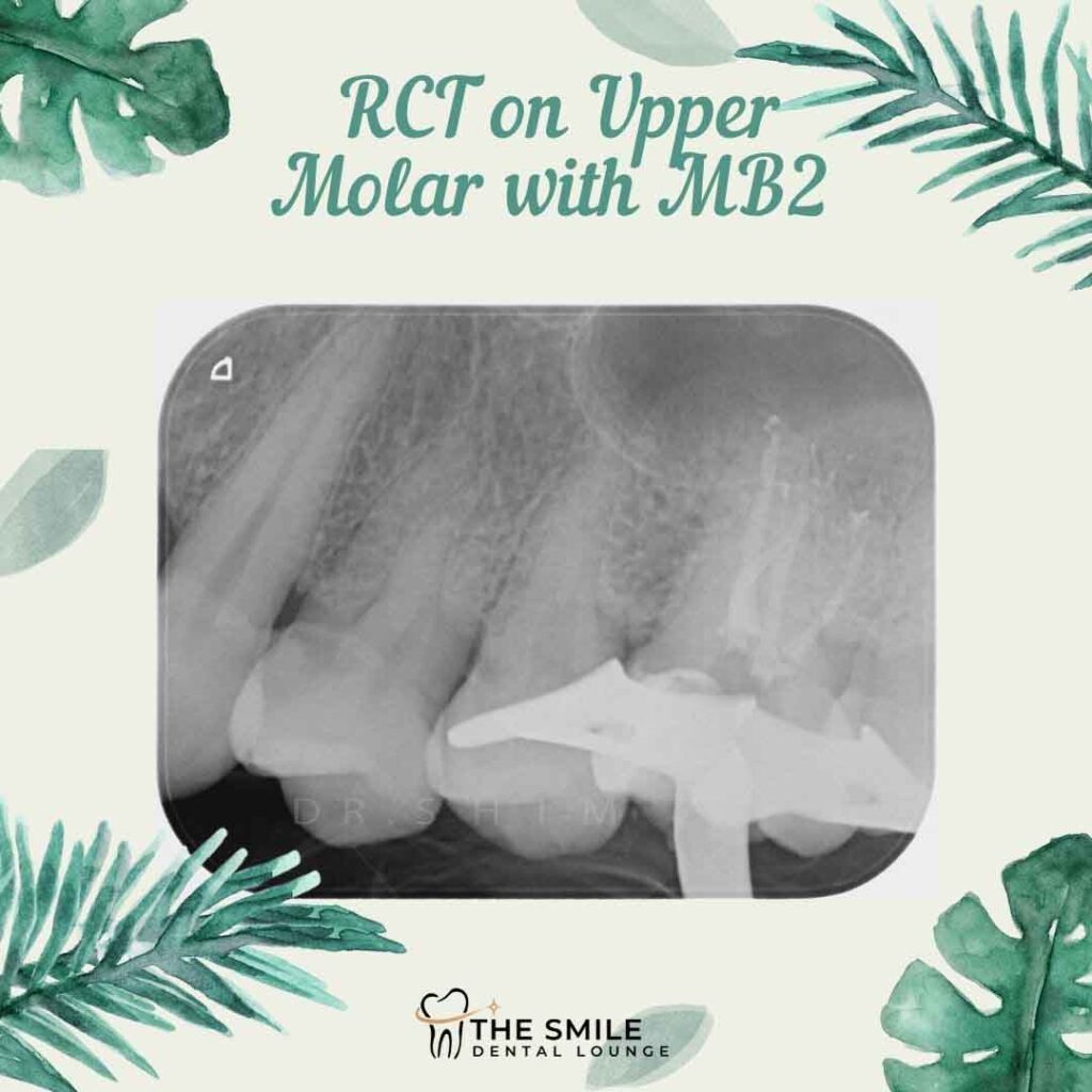 RCT Upper Molar MB2