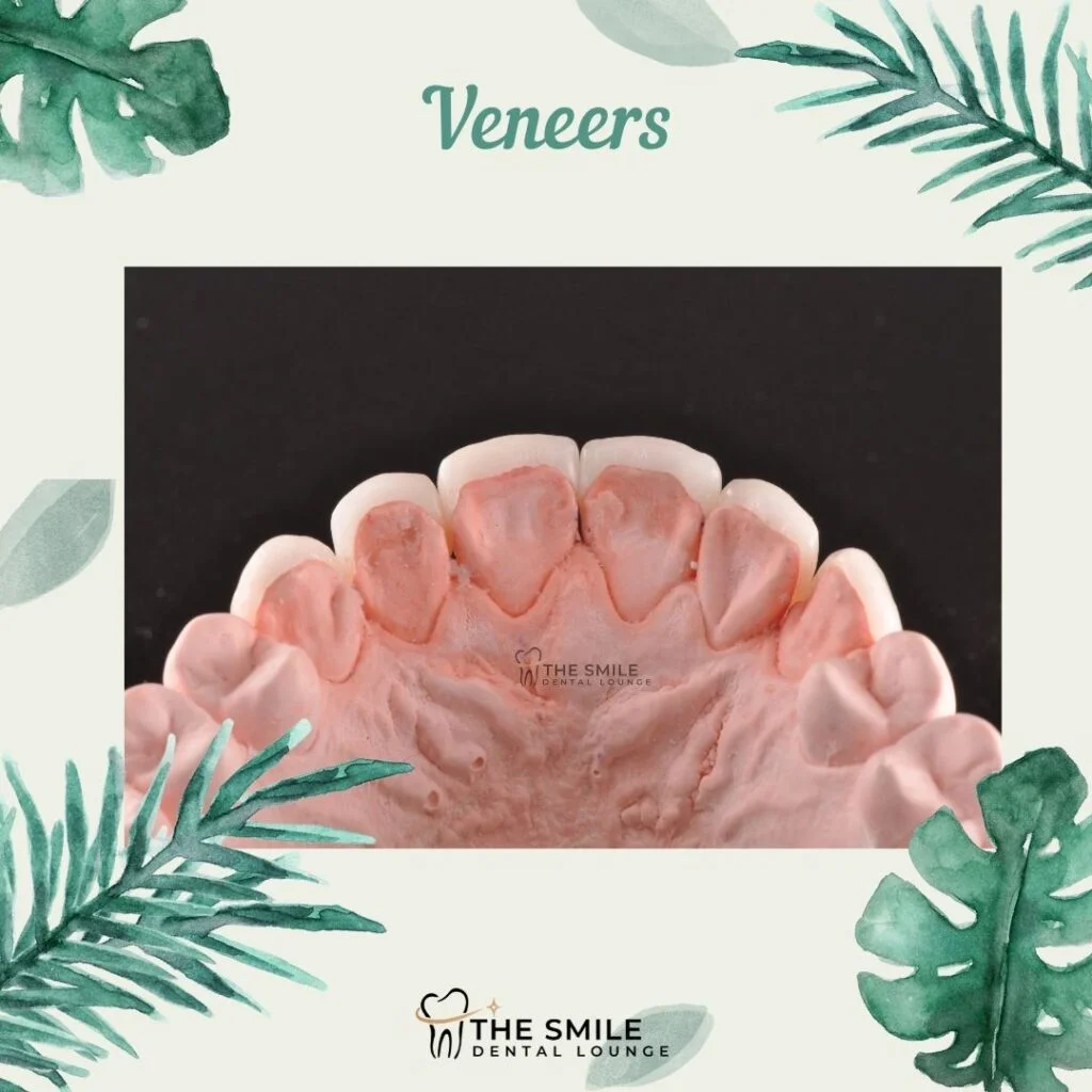 Veneers on tooth model