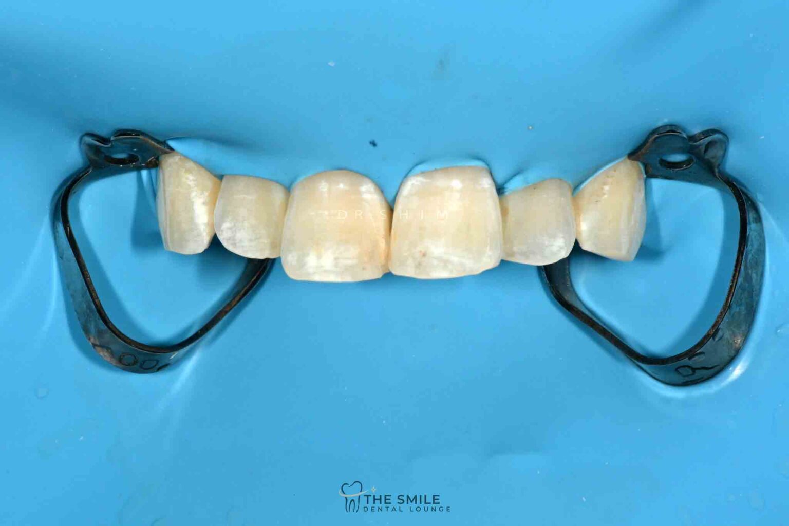 ICON Resin Infiltration The Smile Dental Lounge Dental Clinic Johor