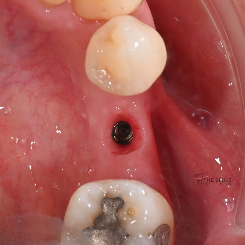 Dental Implant 1