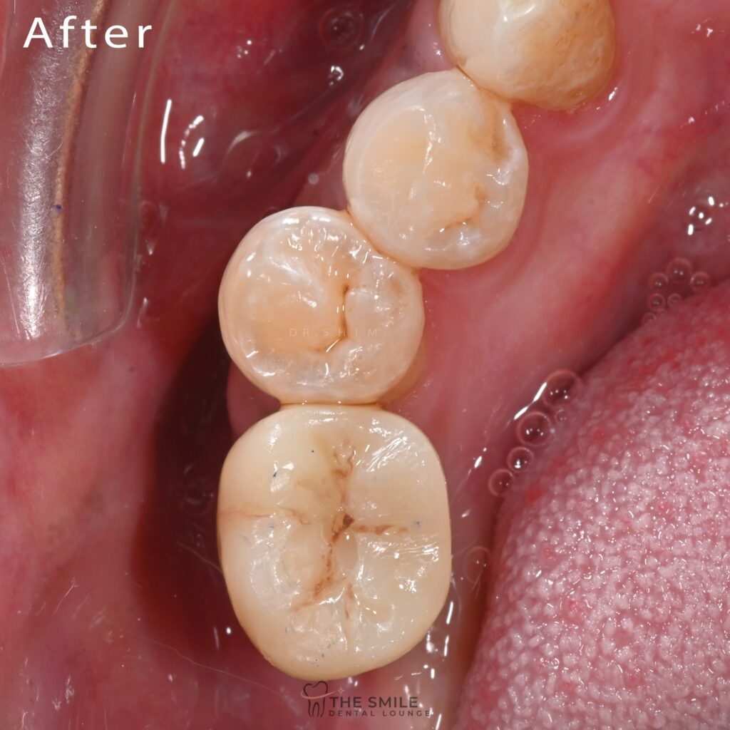 Dental Implant 10