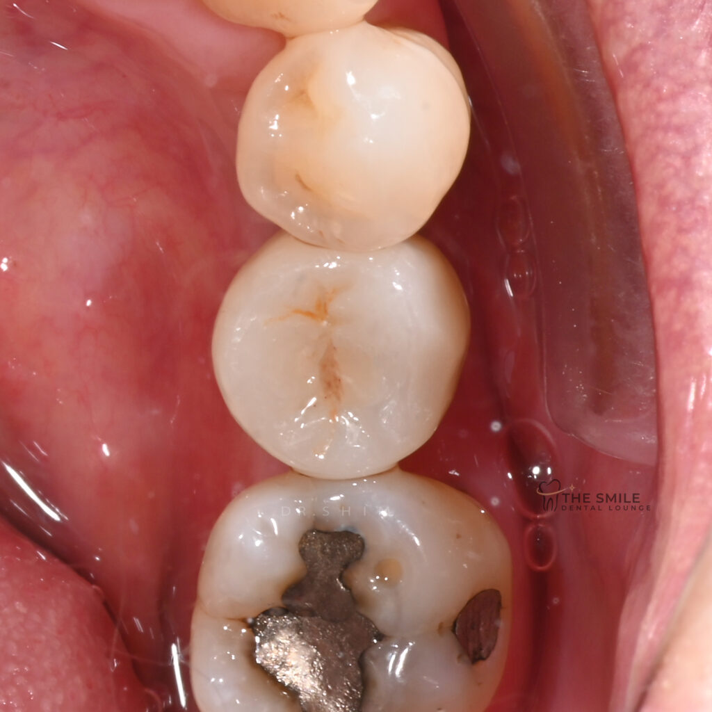 Dental Implant 2