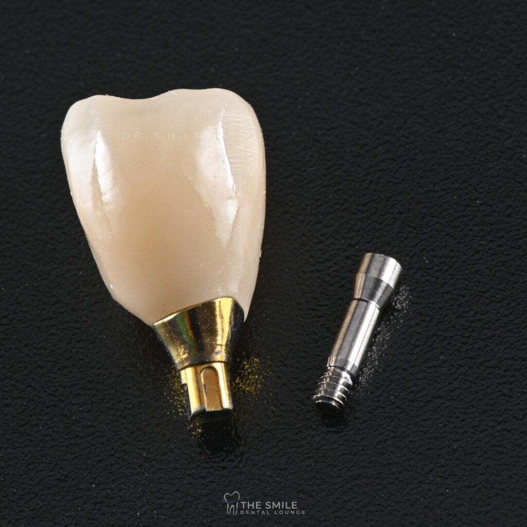 Dental Implant 3
