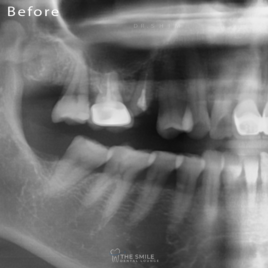 Dental Implant 4