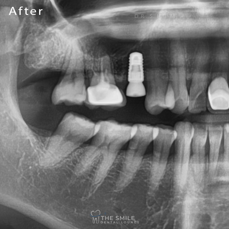 Dental Implant 5
