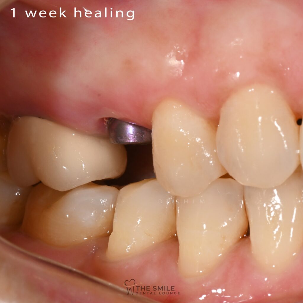 Dental Implant 7