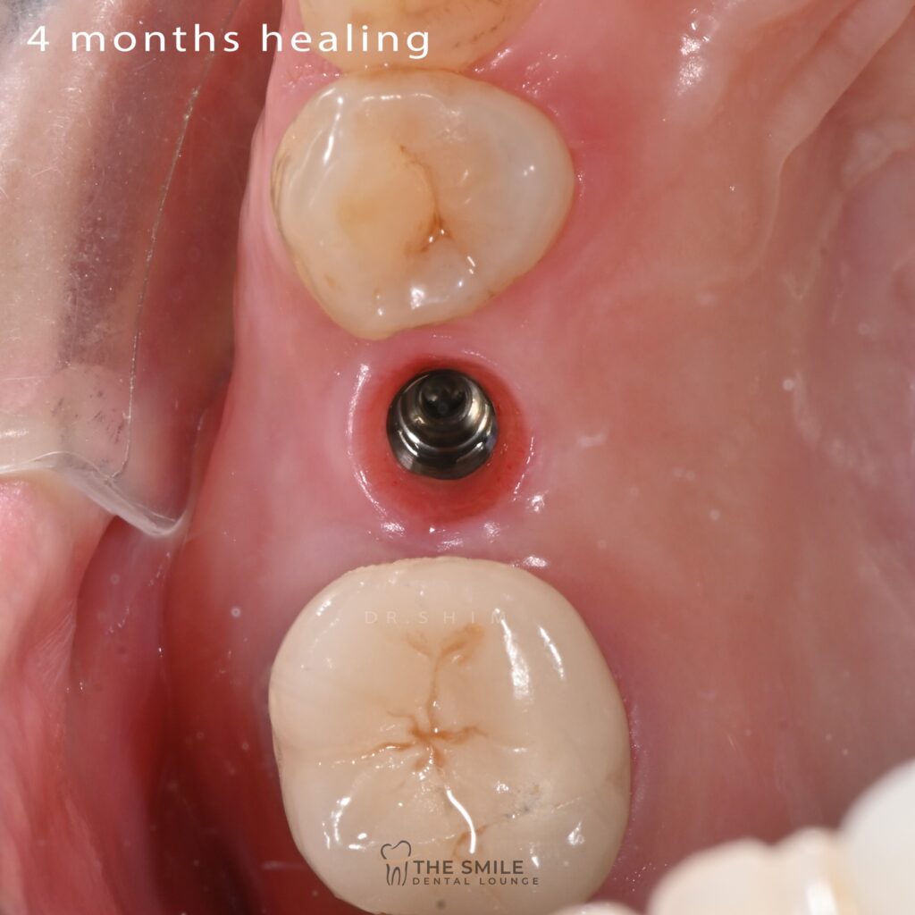 Dental Implant 6