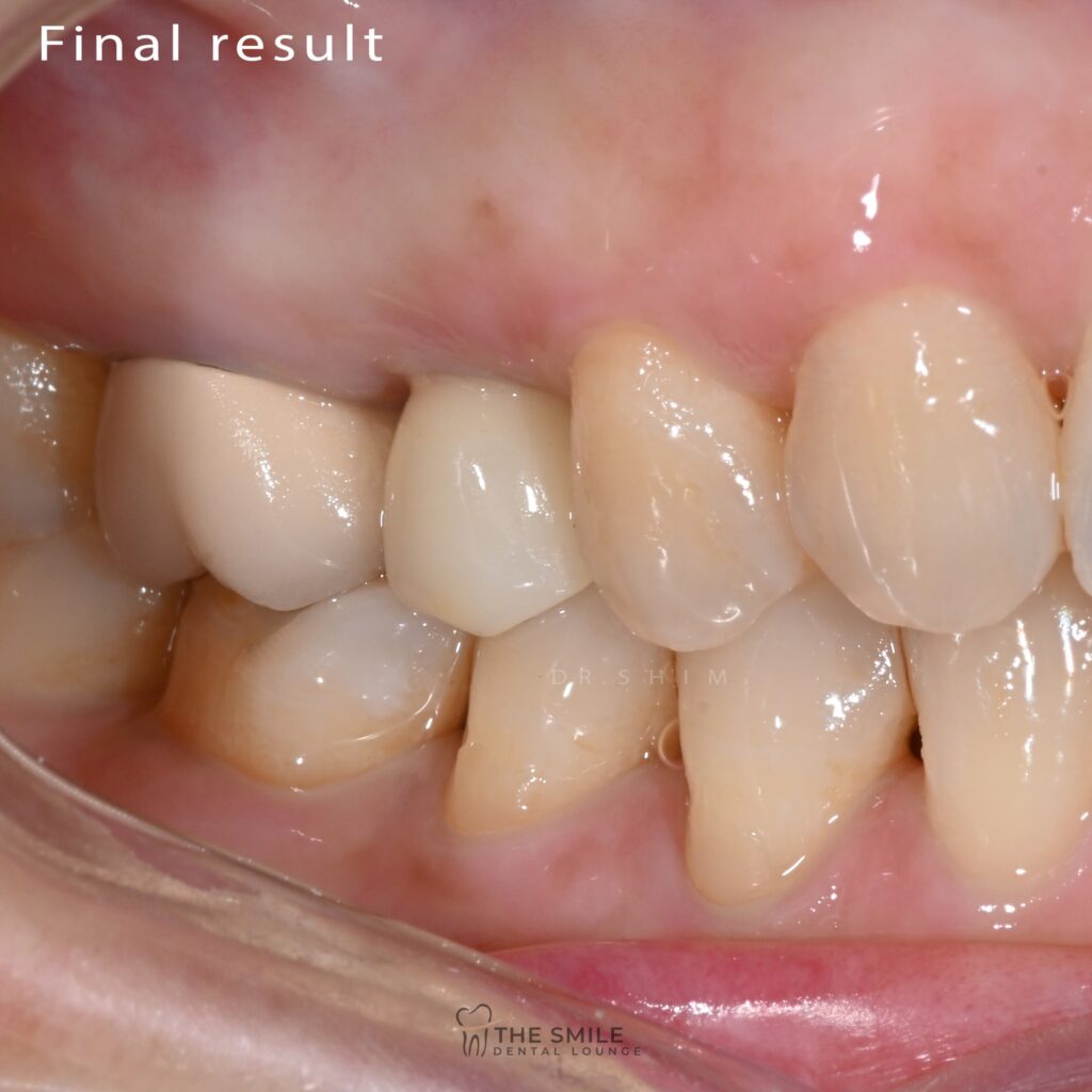 Dental Implant 8