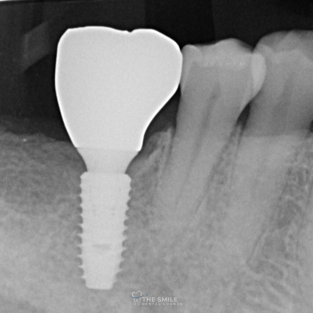 Dental Implant 11