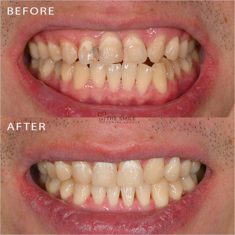 Before After Invisalign JB 1