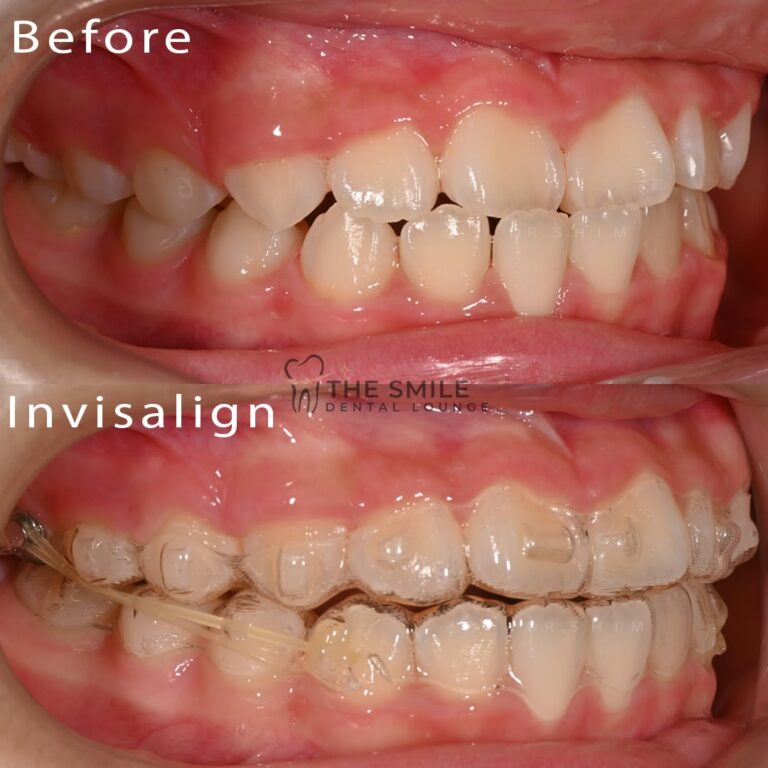 Before After Invisalign JB 2