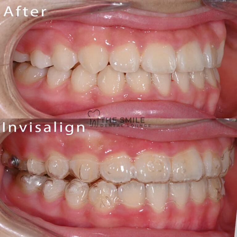Before After Invisalign JB 3