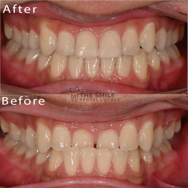Before After Invisalign JB 4