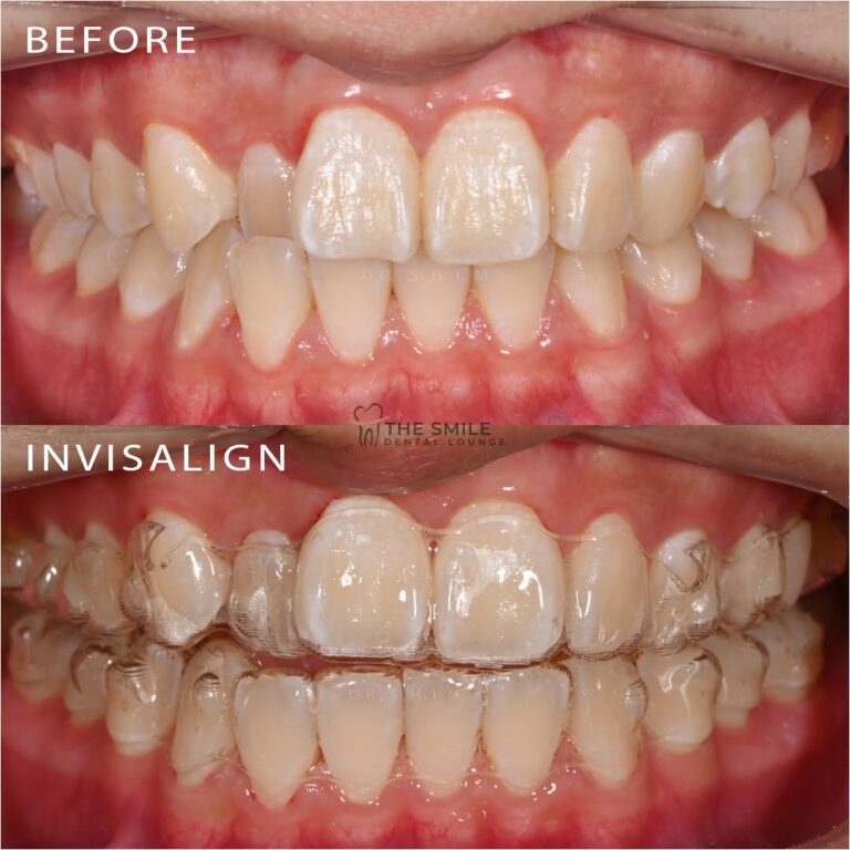 Before After Invisalign JB 5