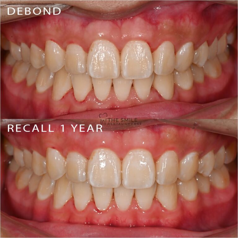 Before After Invisalign JB 6