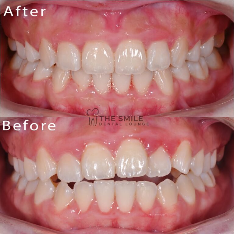 Before After Invisalign JB 7