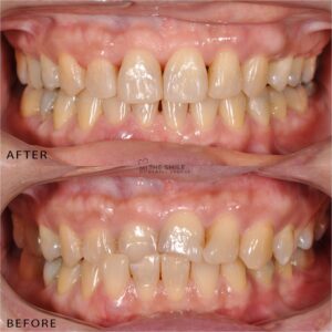 Before After Invisalign Johor bahru 8