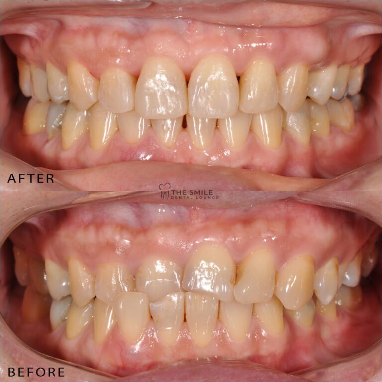 Before After Invisalign Johor bahru 8