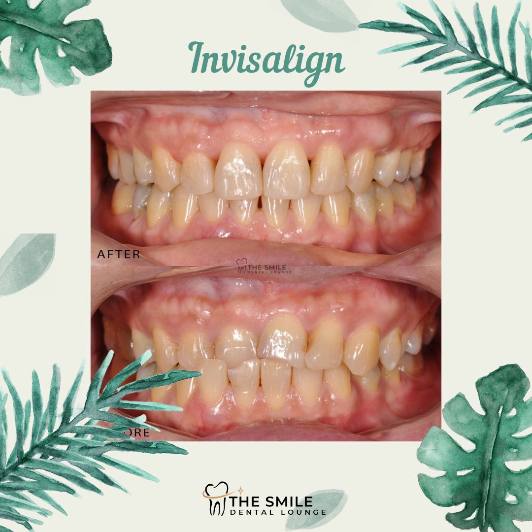 Invisalign Icon